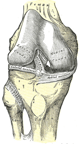 ACL tear