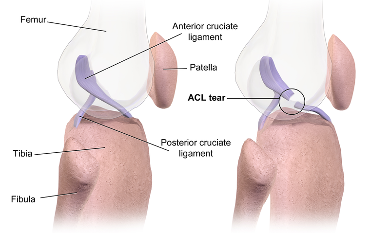 File:ACL Tear.png
Showing the normal ACL and Tear ACL